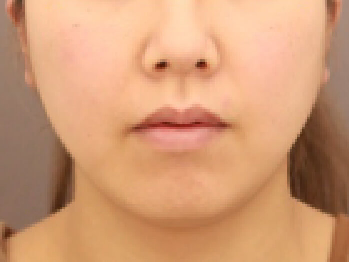 顔の脂肪吸引 比較写真術前 横