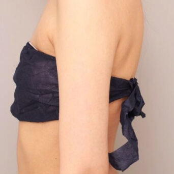 二の腕・肩の脂肪吸引【術後/1ヶ月 25歳女性】の術後写真