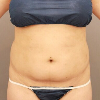 腹部全体+腰の脂肪吸引【術前/6ヶ月 27歳女性】の術前写真