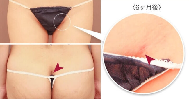 お腹の傷跡の位置