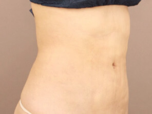 お腹の脂肪吸引 術後1ヶ月写真１