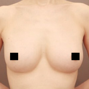 コンデンスリッチ豊胸【術前/6ヶ月 44歳】の術後写真