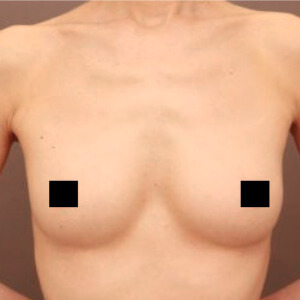 コンデンスリッチ豊胸【術前/6ヶ月 44歳】の術前写真