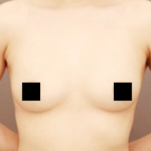 コンデンスリッチ豊胸【術前/6ヶ月 35歳】の術後写真