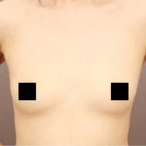 コンデンスリッチ豊胸【術前/6ヶ月 35歳】の術前写真