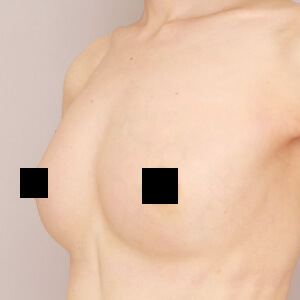 授乳後のコンデンスリッチ豊胸【術前/1ヶ月 40歳】の術後写真