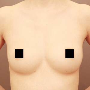 痩せ方のコンデンスリッチ豊胸【術前/6ヶ月 32歳 (BMI:18)】の術後写真