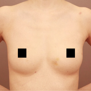 痩せ方のコンデンスリッチ豊胸【術前/6ヶ月 32歳 (BMI:18)】の術前写真