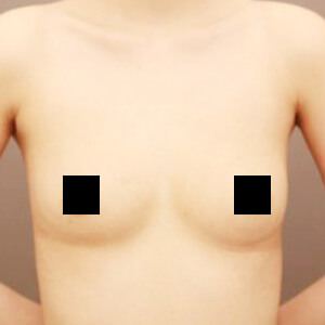 シリコンバッグ抜去後のコンデンスリッチ豊胸【術前/6ヶ月 23歳】の術後写真