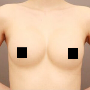シリコンバッグ抜去後のコンデンスリッチ豊胸【術前/6ヶ月 23歳】の術前写真