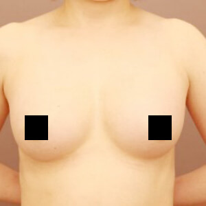 2回目のコンデンスリッチ豊胸【術前/6ヶ月 41歳】の術後写真