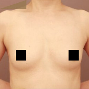 2回目のコンデンスリッチ豊胸【術前/6ヶ月 41歳】の術前写真