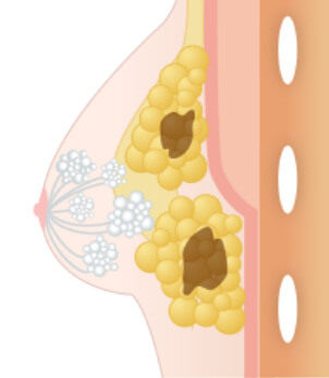 まとめて注入した場合のリスクについての図説