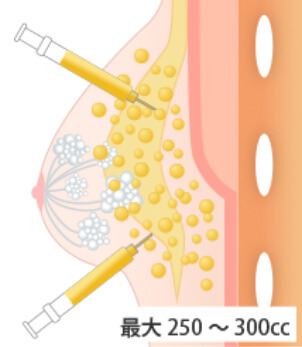 マルチプルインジェクションの図説