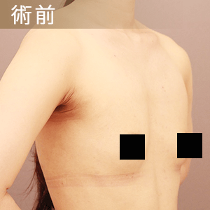 元のサイズが小さい方の症例、術前