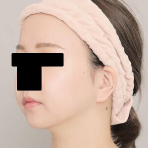 顔(頬・顎下)の脂肪吸引【術前/6ヶ月 26歳女性】の術後写真