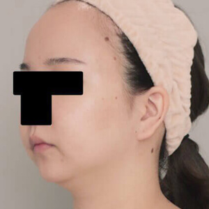 顔(頬・顎下)の脂肪吸引【術前/6ヶ月 26歳女性】の術前写真