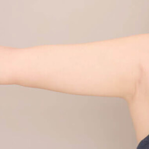 二の腕の脂肪吸引【術前/3ヶ月 27歳女性】の術後写真