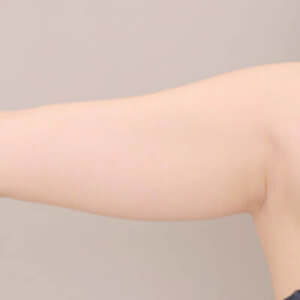 二の腕の脂肪吸引【術前/3ヶ月 27歳女性】の術前写真