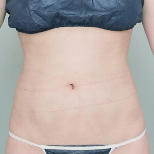 お腹・腰の脂肪吸引【術前/3ヶ月 34歳女性】の術後写真