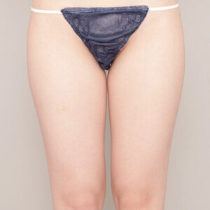 太ももの脂肪吸引【術前/3ヶ月 22歳女性】の術前写真