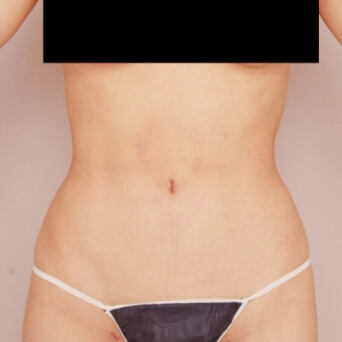 腹部全体+胸下+腰の脂肪吸引【術前/6ヶ月後 21歳女性】の術後写真