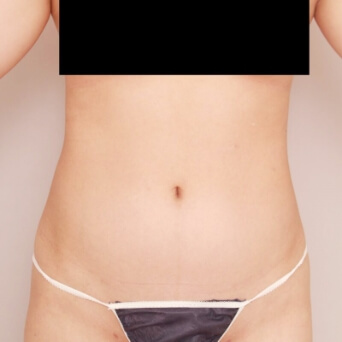 腹部全体+胸下+腰の脂肪吸引【術前/6ヶ月後 21歳女性】の術前写真