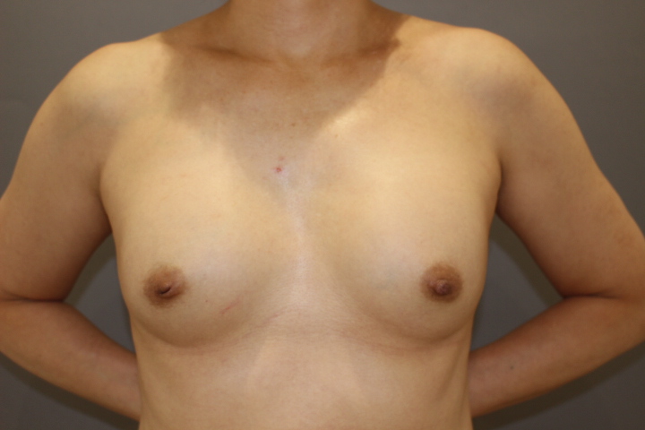 シリコンバック抜去&コンデンスリッチ豊胸 術後1か月