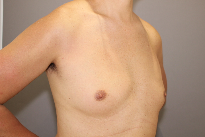 女性化乳房 術後6日目の状態