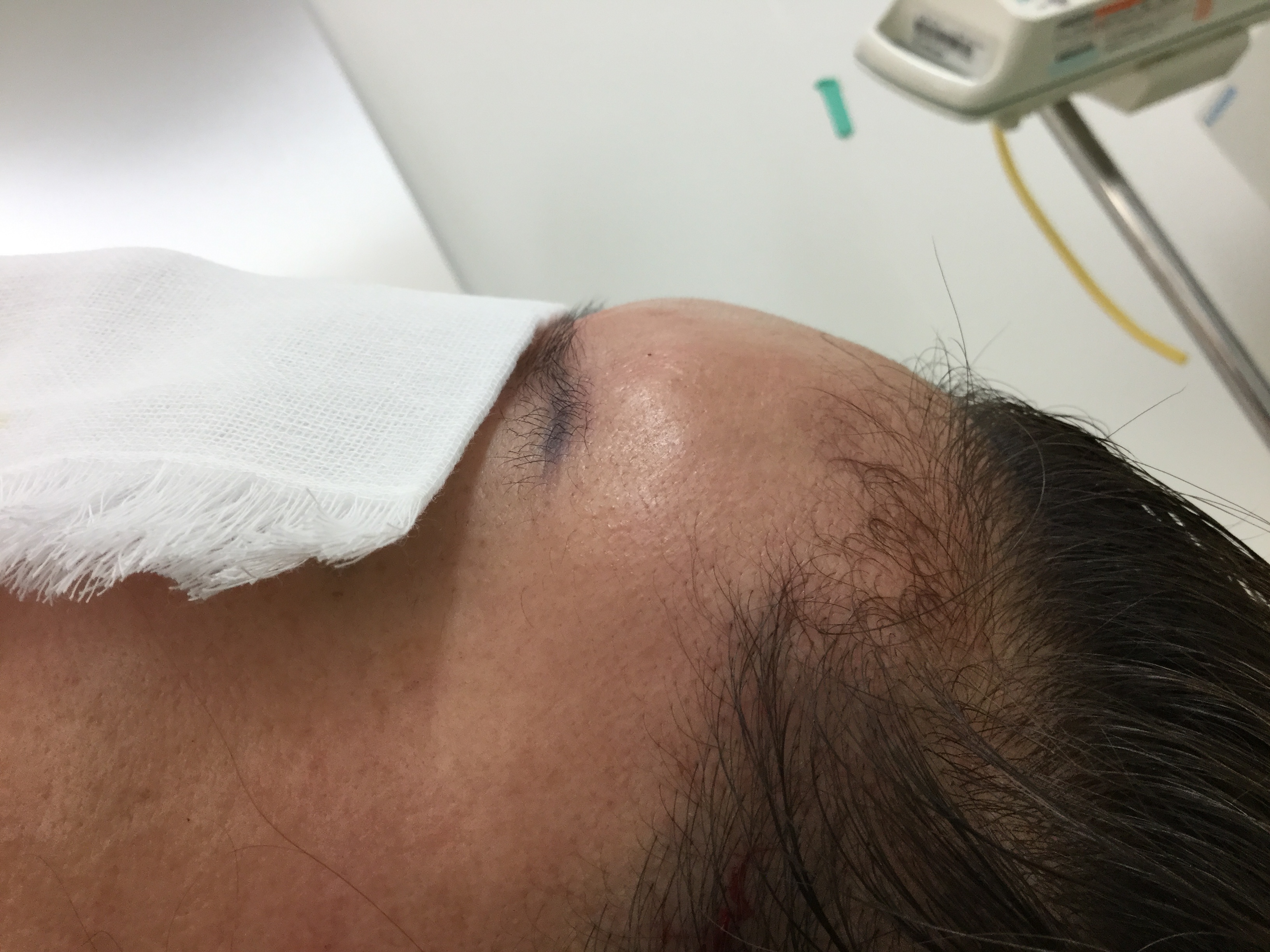 おでこを丸く　コンデンスリッチファット注入