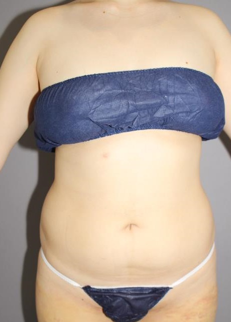 お腹・背中の脂肪吸引後　１週間後の経過