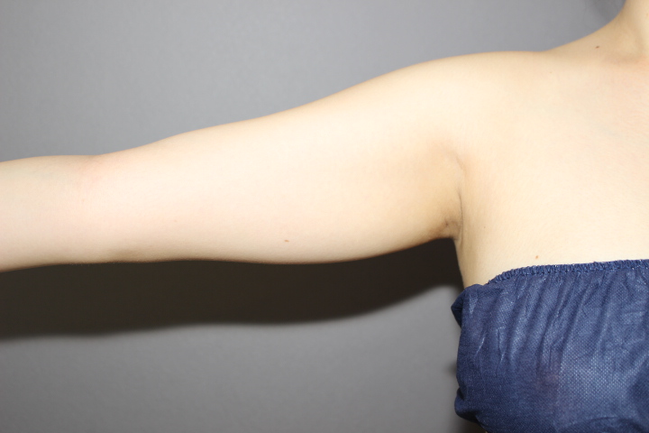 二の腕脂肪吸引　１週間経過