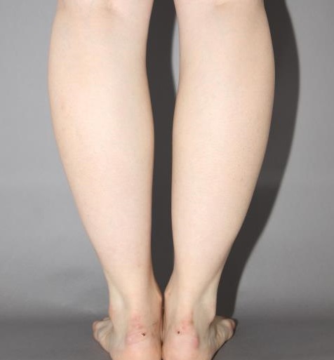 ふくらはぎ脂肪吸引　１週間後　MAXで浮腫んでいる状態