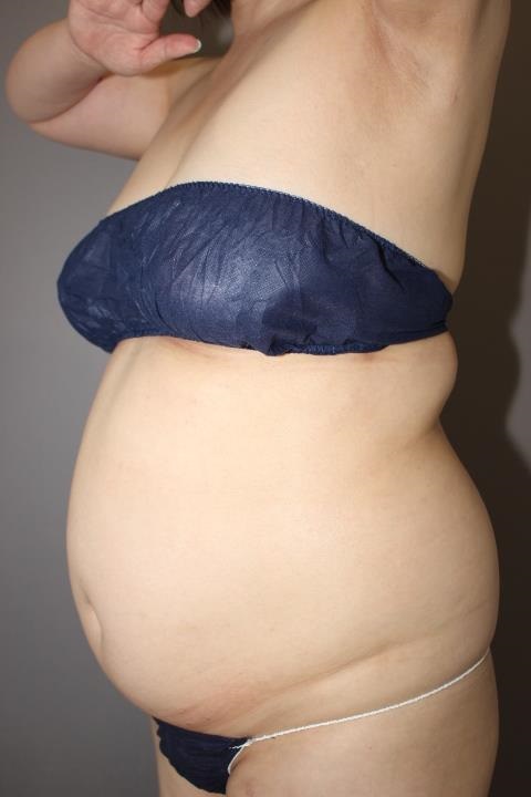 上半身の脂肪吸引　１週間後経過のまとめ