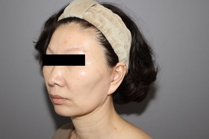 顔への脂肪注入によるエイジングケア　半年後経過