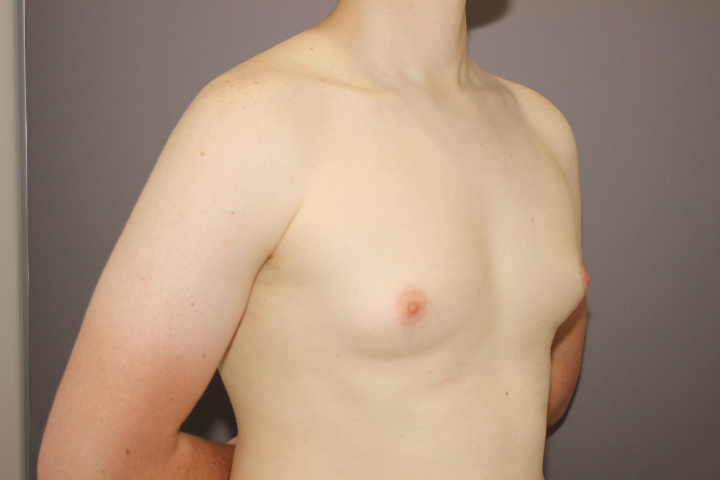 女性化乳房　1か月後