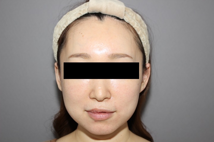 顔の脂肪吸引　１か月経過