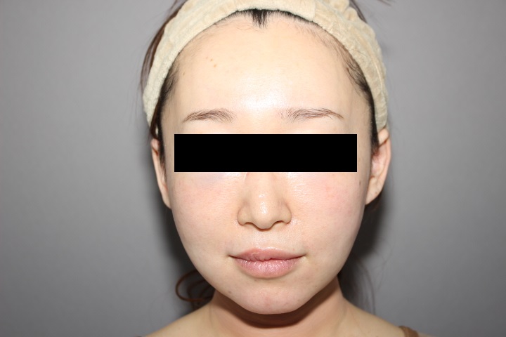 顔の脂肪吸引　術後１日