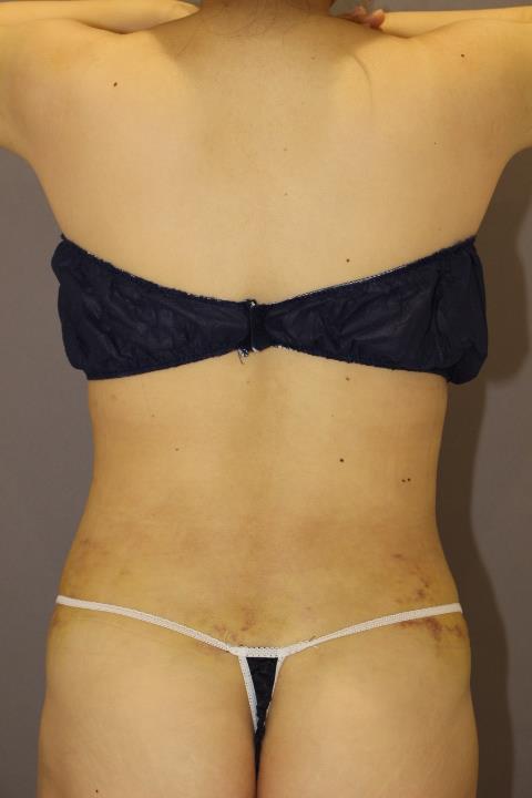 腰の脂肪吸引　　術後１週間