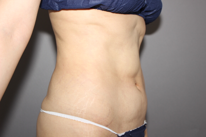 お腹の他院修正　１か月後経過