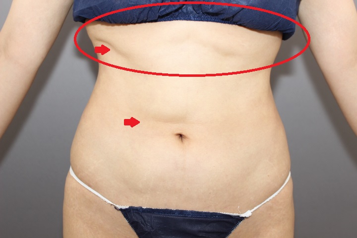 お腹の他院修正　　３か月後経過　