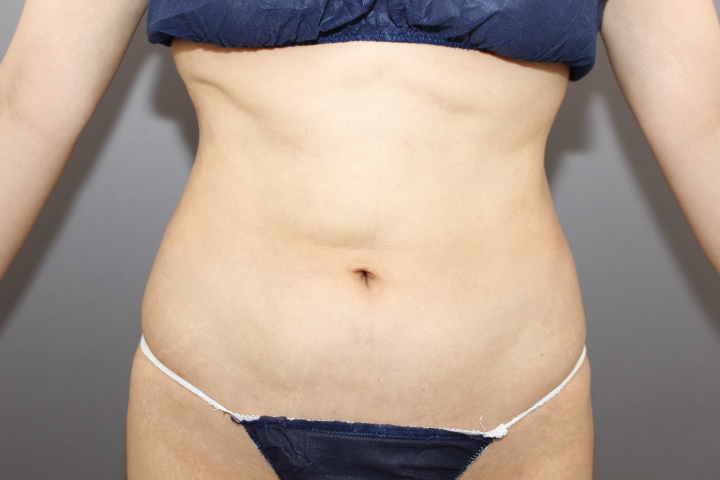 お腹の脂肪吸引 他院修正　動画