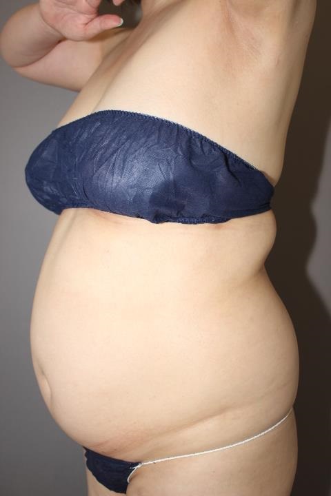 お腹・背中・脇肉の脂肪吸引　１か月半経過