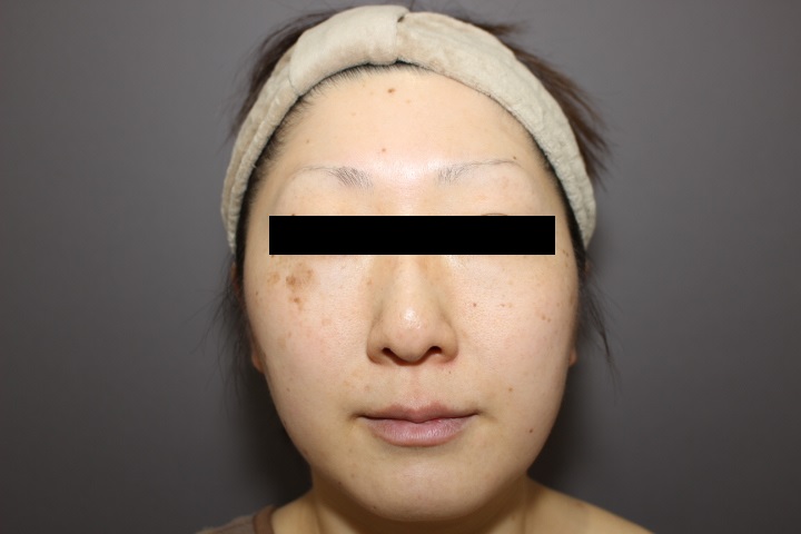 頬・顎の脂肪吸引　１か月経過