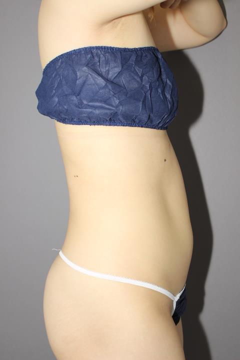 お腹・腰の脂肪吸引　１か月後