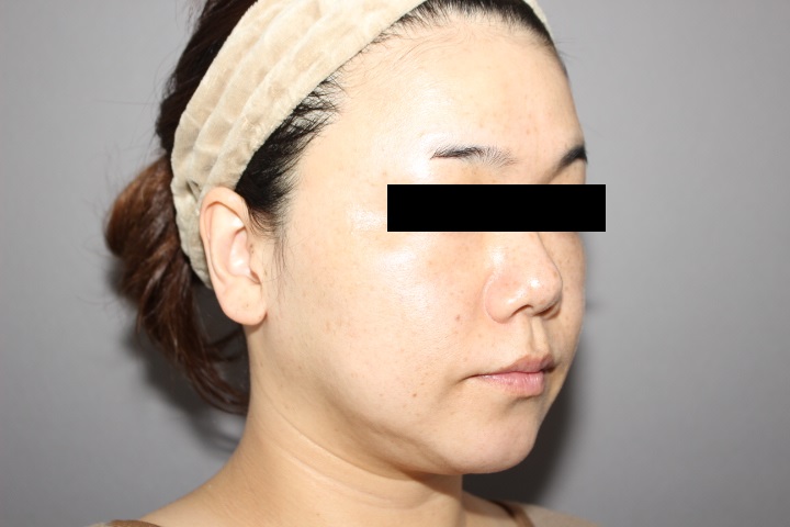 顔の脂肪吸引　２週間後