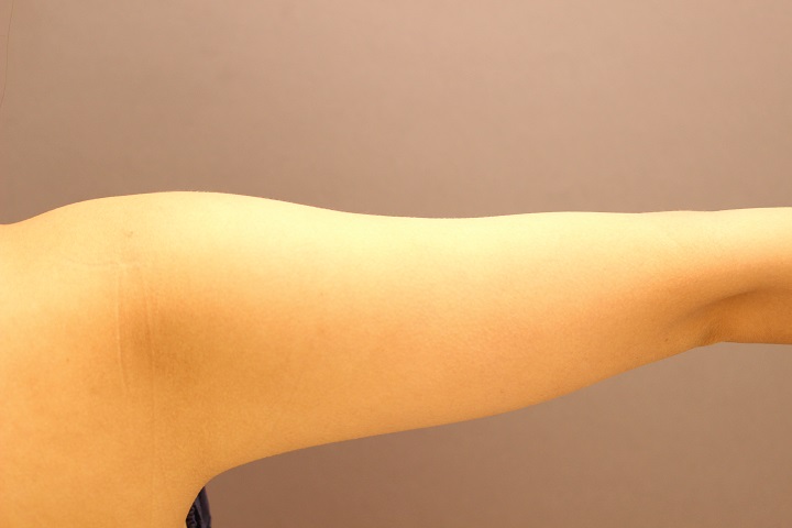 二の腕脂肪吸引　手術翌日の経過