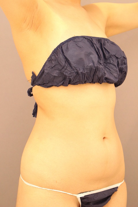 腰の脂肪吸引　　１週間経過