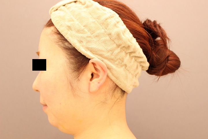 顔の脂肪吸引　１か月後経過