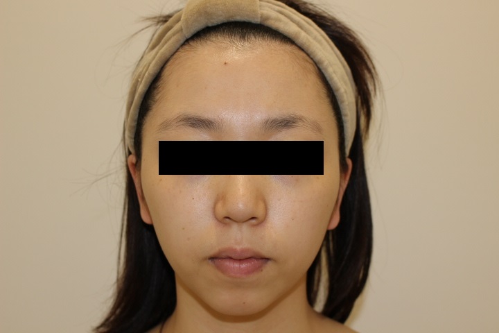バッカルファット除去でコケてしまった頬への脂肪注入　3か月経過